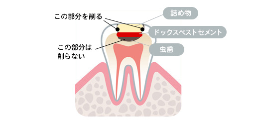 最新虫歯治療法