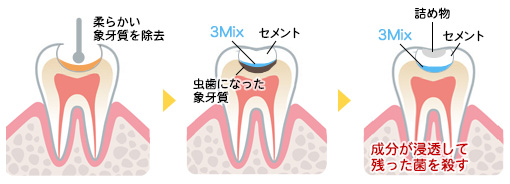 ３Mix法