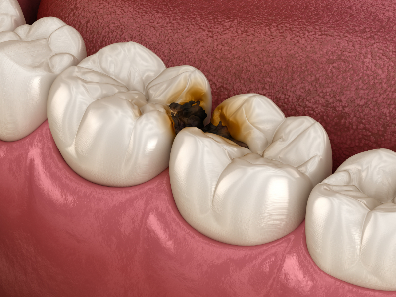 虫歯の初期症状