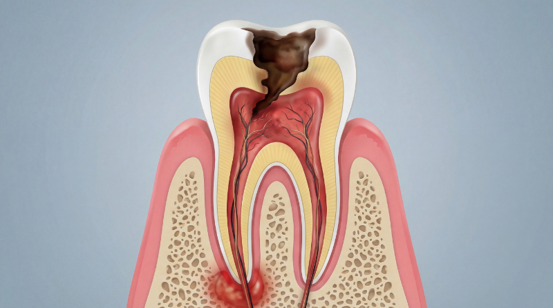 虫歯が進行し歯髄炎症を起こした歯髄