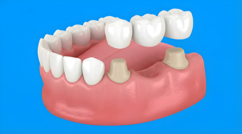 歯のブリッジ治療のイメージ