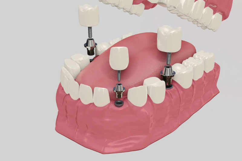 インプラント治療のイメージ