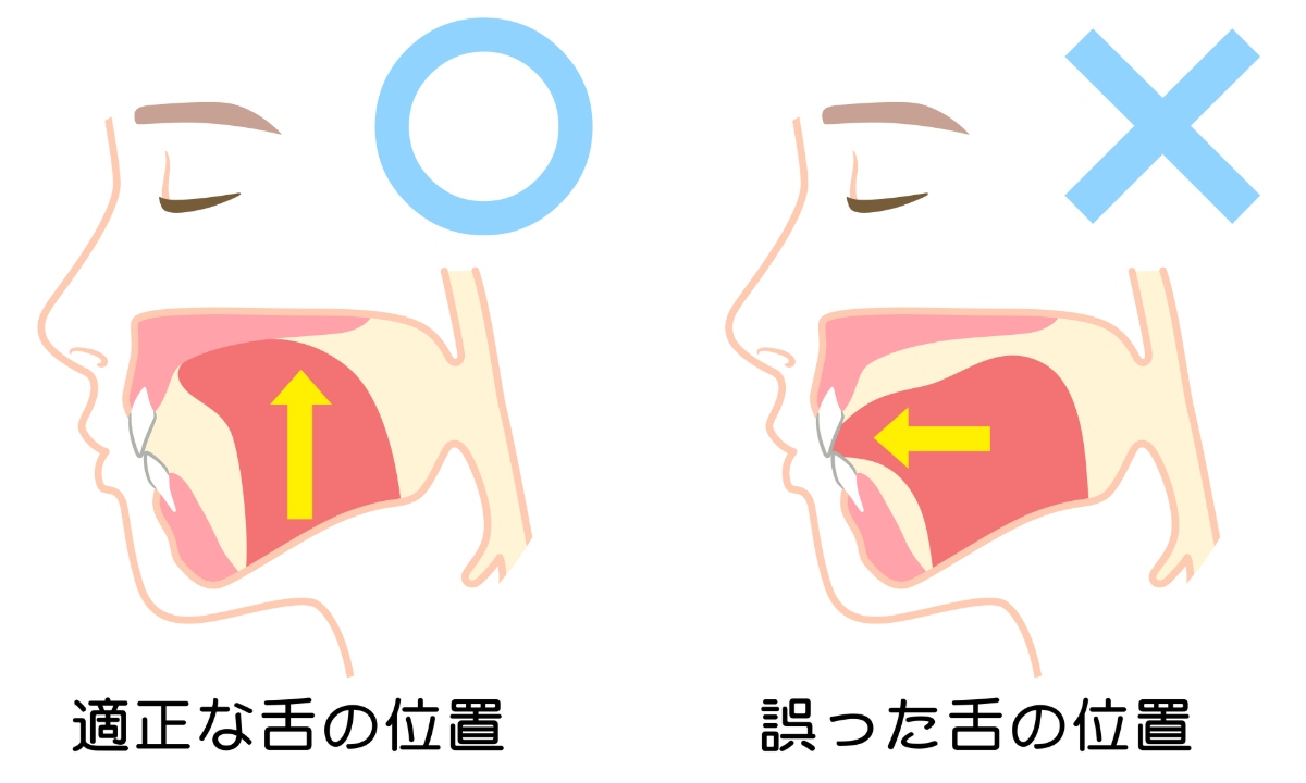 舌の正しい位置と誤った位置の比較図